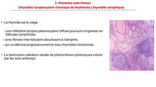 1- Processus auto-immun
(thyroïdite lymphocytaire chronique de Hashimoto ( thyroïdite atrophique)
• La thyroïde est le siège :
- une infiltration lympho-plasmocytaire diffuse pouvant s’organiser en
follicules lymphoïdes
- avec fibrose inter-lobulaire aboutissant à l’atrophie,
- qui va détruire progressivement le tissu thyroïdien fonctionnel.
• La destruction cellulaire résulte de phénomènes cytotoxiques induits
par les auto-anticorps.
 