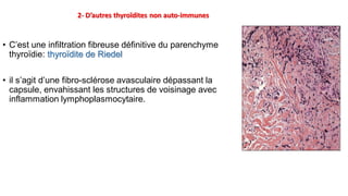 2- D’autres thyroïdites non auto-immunes
• C’est une infiltration fibreuse définitive du parenchyme
thyroïdie: thyroïdite de Riedel
• il s’agit d’une fibro-sclérose avasculaire dépassant la
capsule, envahissant les structures de voisinage avec
inflammation lymphoplasmocytaire.
 
