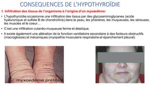 CONSEQUENCES DE L’HYPOTHYROÏDIE
1. Infiltration des tissus de l’organisme à l’origine d’un myxœdème:
• L'hypothyroïdie occasionne une infiltration des tissus par des glycosaminoglycanes (acide
hyaluronique et sulfate B de chondroïtine) dans la peau, les phanères, les muqueuses, les séreuses,
les muscles et le coeur…
• C’est une infiltration cutanéo-muqueuse ferme et élastique.
• Il existe également une altération de la fonction ventilatoire secondaire à des facteurs obstructifs
(macroglossie) et mécaniques (myopathie musculaire respiratoire et épanchement pleural).
 