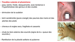 • Troubles cutanés et phanériens:
- peau sèche, froide, desquamante, avec tendance à
l’hyperkératose des genoux et des coudes
- diminution de la sudation
- teint caroténoïde (jaune orangé) des paumes des mains et des
plantes des pieds
- cheveux et ongles secs, fragilisés et cassants
- chute du tiers externe des sourcils (signe de la « queue des
sourcils»)
- Raréfaction de la pilosité axillaire et pubienne
 