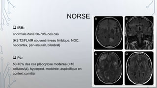  IRM:
anormale dans 50-70% des cas
(HS T2/FLAIR souvent niveau limbique, NGC,
neocortex, péri-insulair, bilatéral)
 PL:
50-70% des cas pléocytose modérée (<10
cellules/μl), hyperprot. modérée, aspécifique en
context comitial
NORSE
 