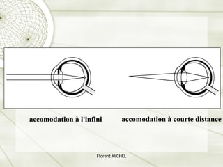 Florent MICHEL
accomodation à l'infini accomodation à courte distance
 
