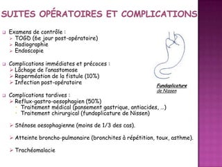 





Examens de contrôle :
 TOGD (6e jour post-opératoire)
 Radiographie
 Endoscopie
Complications immédiates et précoces :
 Lâchage de l’anastomose
 Reperméation de la fistule (10%)
 Infection post-opératoire

Fundoplicature
de Nissen

Complications tardives :
 Reflux-gastro-oesophagien (50%)
• Traitement médical (pansement gastrique, antiacides, …)
• Traitement chirurgical (fundoplicature de Nissen)
 Sténose oesophagienne (moins de 1/3 des cas).

 Atteinte broncho-pulmonaire (bronchites à répétition, toux, asthme).
 Trachéomalacie

 