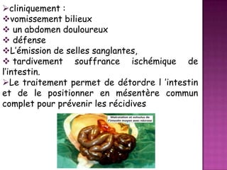 cliniquement :
vomissement bilieux
 un abdomen douloureux
 défense
L’émission de selles sanglantes,
 tardivement souffrance ischémique de
l’intestin.
Le traitement permet de détordre l ’intestin
et de le positionner en mésentère commun
complet pour prévenir les récidives

 