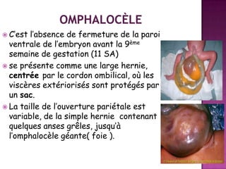  C’est

l’absence de fermeture de la paroi
ventrale de l’embryon avant la 9ème
semaine de gestation (11 SA)
 se présente comme une large hernie,
centrée par le cordon ombilical, où les
viscères extériorisés sont protégés par
un sac.
 La taille de l’ouverture pariétale est
variable, de la simple hernie contenant
quelques anses grêles, jusqu’à
l’omphalocèle géante( foie ).

 