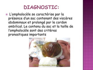 

L’omphalocèle se caractérise par la
présence d’un sac contenant des viscères
abdominaux et prolongé par le cordon
ombilical. Le contenu du sac et la taille de
l’omphalocèle sont des critères
pronostiques importants

 