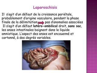 Laparoschisis
Il s’agit d’un défaut de la croissance pariétale,
probablement d’origine vasculaire, pendant la phase
finale de la délimitation
pas d’anomalies associées
Il s’agit d’un défaut latéro-ombilical droit, sans sac,
les anses intestinales baignent dans le liquide
amniotique. L’aspect des anses est encouenné et
cartonné, à des degrés variables.

 