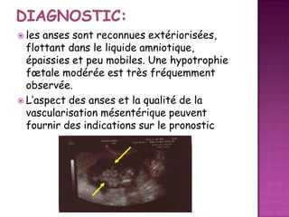  les

anses sont reconnues extériorisées,
flottant dans le liquide amniotique,
épaissies et peu mobiles. Une hypotrophie
fœtale modérée est très fréquemment
observée.
 L’aspect des anses et la qualité de la
vascularisation mésentérique peuvent
fournir des indications sur le pronostic

 