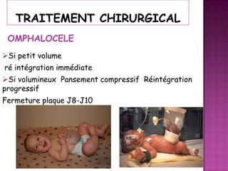 OMPHALOCELE
Si petit volume
ré intégration immédiate

Si volumineux Pansement compressif Réintégration
progressif
Fermeture plaque J8-J10

 