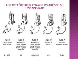 Type I

Type II

Type III

Type IV

Type V

Atrésie isolée
sans fistule

Atrésie avec
fistule trachéooesophagienne
dans le segment
supérieur

Atrésie avec
fistule trachéooesophagienne
dans le segment
inférieur

Variante du
type III

Deux ou
plusieurs fistules

7 - 10%

1%

80 - 85%

4%

2-3%

 