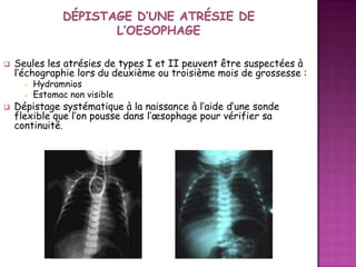 

Seules les atrésies de types I et II peuvent être suspectées à
l’échographie lors du deuxième ou troisième mois de grossesse :





Hydramnios
Estomac non visible

Dépistage systématique à la naissance à l’aide d’une sonde
flexible que l’on pousse dans l’œsophage pour vérifier sa
continuité.

 