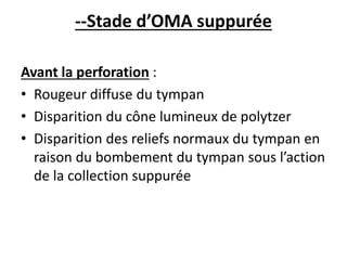 --Stade d’OMA suppurée
Avant la perforation :
• Rougeur diffuse du tympan
• Disparition du cône lumineux de polytzer
• Disparition des reliefs normaux du tympan en
raison du bombement du tympan sous l’action
de la collection suppurée
 