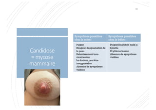 Candidose
= mycose
mammaire
Symptômes possibles
chez la mère :
Symptômes possibles
chez le bébé :
Plaque
Rougeur, desquamation de
la peau
Ralentissement/non-
cicatrisation
La douleur peut être
insupportable
Absence de symptômes
visibles
Plaques blanches dans la
bouche
Érythème fessier
Absence de symptômes
visibles
49
 