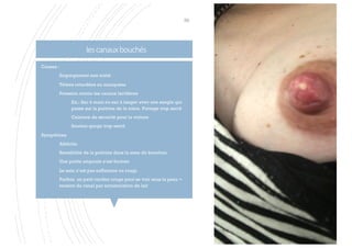 lescanauxbouchés
59
Causes :
§ Engorgement non traité
§ Tétées retardées ou manquées
§ Pression contre les canaux lactifères
§ Ex.: Sac à main ou sac à langer avec une sangle qui
passe sur la poitrine de la mère. Portage trop serré
§ Ceinture de sécurité pour la voiture
§ Soutien-gorge trop serré
Symptômes
§ Afébrile
§ Sensibilité de la poitrine dans la zone du bouchon.
§ Une petite ampoule s’est formée
§ Le sein n’est pas enflammé ou rougi.
§ Parfois, un petit cordon rouge peut se voir sous la peau =
tension du canal par accumulation de lait
 