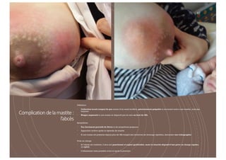 Complicationdelamastite:
l’abcès
67
Définition
• Collection locale (coque) de pus autour d’un canal lactifère, généralement palpable et survenant suite à une mastite, mais pas
toujours.
• Risque augmenté si une masse ne disparaît pas du sein au bout de 48h.
Symptômes
• Pas forcément précédé de fièvre ni de symptômes grippaux.
• Apparition tardive après un épisode de mastite
• Si une masse est présente depuis plus de 48h malgré des tentatives de drainage répétées, demander une échographie.
Prise en charge
• Si l’abcès est confirmé, il sera soit ponctionné et aspiré (préférable, mais la réussite dépend d’une prise en charge rapide),
ou opéré.
• L’allaitement reste possible avant et après la ponction
 