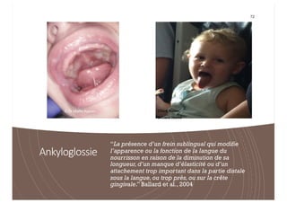 Ankyloglossie
72
“La présence d’un frein sublingual qui modifie
l’apparence ou la fonction de la langue du
nourrisson en raison de la diminution de sa
longueur, d’un manque d’élasticité ou d’un
attachement trop important dans la partie distale
sous la langue, ou trop près, ou sur la crête
gingivale.” Ballard et al., 2004
© Dr Martin Kaplan Chloé Masse,
© Carol Hervé
 