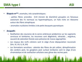 • Anapath:
– Raréfaction des neurones de la corne antérieure prédomine sur les segments
cervicaux et lombaires, les neurones sont dégénèrés, rétractés , anguleux,
souvent de coloration foncée avec présence de masse argyrophiles
– Les noyaux des nerfs crâniens sont le siège d’une dépopulation neuronale
(Vm, VI, VII, X, XI, XII)
– Les formations sensitives: -atteinte des fibres de ptt calibre, démyélinisation
des cordons post, les ganglions post surtout lombaires sont le siège d’une
chromatolyse et de raréfaction cellulaire avec gliose des racines post.
SMA type I ASI
• Biopsie maire: anomales, très caractéristiques:
- petites fibres arrondies (5-8 microm de diamètre) groupées en faisceaux
avoisinant des Fx normaux ou hypertrophiques, un halo riche en ribosome
autour des fibres atrophiques
- anomalies nucléaires limitées à de petits bouquets pycnotiques
 