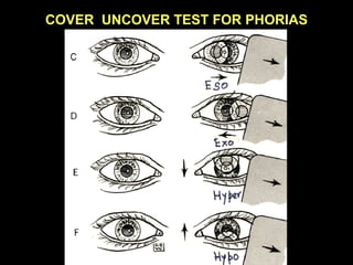fig.c,d,e,f (fig.29)
COVER UNCOVER TEST FOR PHORIAS
 
