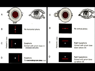 fig.34,35
UNCROSSED DIPLOPIA
CROSSED DIPLOPIA
 