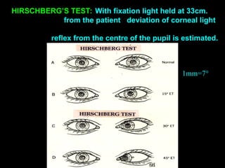 HIRSCHBERG’S TEST::With fixation light held at 33cm.
from the patient deviation of corneal light
reflex from the centre of the pupil is estimated.
1mm=7°
 