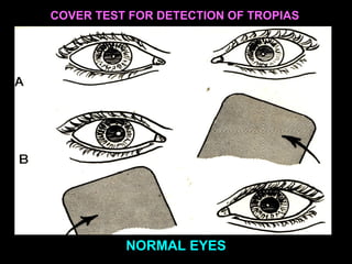 fig.27 a,b,c
COVER TEST FOR DETECTION OF TROPIAS
C NORMAL EYES
 