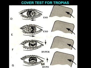 fig.27D,E,F,G
ESO
EXO
HYPO
HYPER
COVER TEST FOR TROPIAS
 