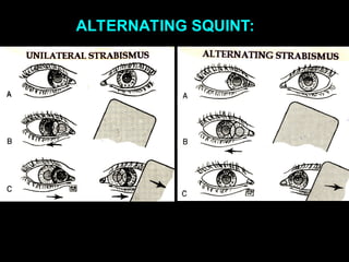ALTERNATING SQUINT:
 