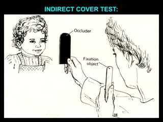 INDIRECT COVER TEST:
 
