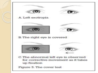 Cover Uncover Test