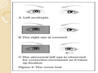 Covertests.pptx type of cover test use of cover test | PPTX