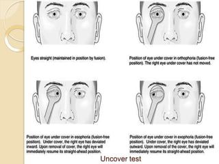 Cover Test Instrument Covertests.pptx type of cover test use of cover test | PPTX