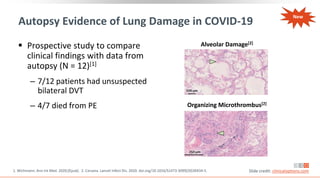 Autopsy Evidence of Lung Damage in COVID-19
 Prospective study to compare
clinical findings with data from
autopsy (N = 12)[1]
‒ 7/12 patients had unsuspected
bilateral DVT
‒ 4/7 died from PE
Alveolar Damage[2]
Organizing Microthrombus[2]
1. Wichmann. Ann Int Med. 2020;[Epub]. 2. Carsana. Lancet Infect Dis. 2020. doi.org/10.1016/S1473-3099(20)30434-5. Slide credit: clinicaloptions.com
New
 
