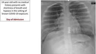 14-year-old with no medical
history presents with
shortness of breath and
hypoxia in the setting of
known COVID-19 exposure.
Day of Admission
 