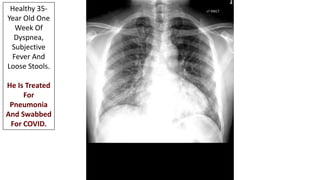 Healthy 35-
Year Old One
Week Of
Dyspnea,
Subjective
Fever And
Loose Stools.
He Is Treated
For
Pneumonia
And Swabbed
For C...