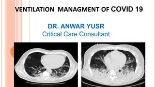 VENTILATION MANAGMENT OF COVID 19
DR. ANWAR YUSR
Critical Care Consultant
 
