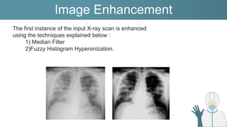 Image Segmentation
The second instance of the input X-ray scan
1)U-Net Model
2)Image Filtering for segmentation
 