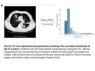 Panel A: CT scan acquired during spontaneous breathing. The cumulative distribution of
the CT number is shifted to the left (well aerated compartments), being the 0 to -100 HU
compartment, the nonaerated tissue virtually 0. Indeed, the total lung tissue weight was
1108 g, 7.8% of which was not aerated and the gas volume was 4228 ml. Patient receiving
oxygen with Venturi mask, inspired oxygen fraction of 0.8.
 