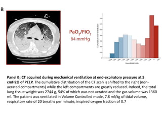 Panel B: CT acquired during mechanical ventilation at end-expiratory pressure at 5
cmH2O of PEEP. The cumulative distribution of the CT scan is shifted to the right (non-
aerated compartments) while the left compartments are greatly reduced. Indeed, the total
lung tissue weight was 2744 g, 54% of which was not aerated and the gas volume was 1360
ml. The patient was ventilated in Volume Controlled mode, 7.8 ml/kg of tidal volume,
respiratory rate of 20 breaths per minute, inspired oxygen fraction of 0.7
 