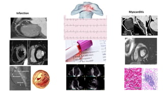 Myocarditis
Infarction
 