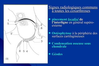 Signes radiologiques communsSignes radiologiques communs
à toutes les coxarthrosesà toutes les coxarthroses
 pincementpincement localisélocalisé dede
l’interlignel’interligne en général supéro-en général supéro-
externeexterne
 OstéophytoseOstéophytose à la périphérie desà la périphérie des
surfaces cartilagineusessurfaces cartilagineuses
 Condensation osseuse sousCondensation osseuse sous
chondralechondrale
 GéodesGéodes
 
