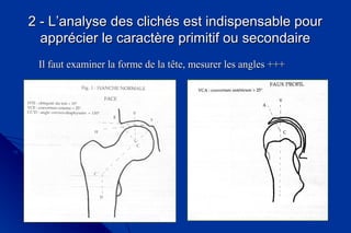 2 - L’analyse des clichés est indispensable pour2 - L’analyse des clichés est indispensable pour
apprécier le caractère primitif ou secondaireapprécier le caractère primitif ou secondaire
Il faut examiner la forme de la tête, mesurer les angles +++Il faut examiner la forme de la tête, mesurer les angles +++
 