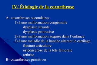 IV/ Étiologie de la coxarthroseIV/ Étiologie de la coxarthrose
AA-- coxarthroses secondairescoxarthroses secondaires
1) à une malformation congénitale1) à une malformation congénitale
dysplasie luxantedysplasie luxante
dysplasie protrusivedysplasie protrusive
2) à une malformation acquise dans l’enfance2) à une malformation acquise dans l’enfance
3) à une maladie de la hanche altérant le cartilage3) à une maladie de la hanche altérant le cartilage
fracture articulairefracture articulaire
ostéonécrose de la tête fémoraleostéonécrose de la tête fémorale
arthritearthrite
B- coxarthroses primitives
 