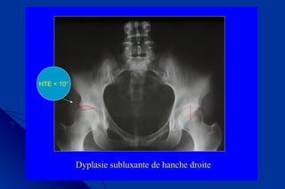 Dyplasie subluxante de hanche droite
HTE < 10°
 