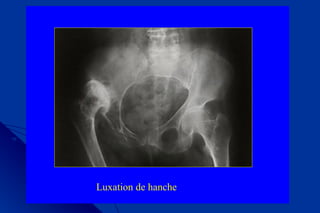 Luxation de hanche
 