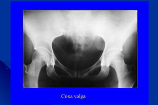 Coxa valga
 