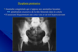 Dysplasie protrusiveDysplasie protrusive
• Anomalie congénitale qui s’oppose aux anomalies luxantesAnomalie congénitale qui s’oppose aux anomalies luxantes
pénétration excessive de la tête fémorale dans le cotylepénétration excessive de la tête fémorale dans le cotyle
• S’associent fréquemment une coxa vara et un toit hypercouvrantS’associent fréquemment une coxa vara et un toit hypercouvrant
 