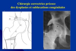 Chirurgie correctrice précoce
des dysplasies et subluxations congénitales
-
 