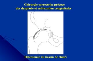 Chirurgie correctrice précoce
des dysplasie et subluxation congénitales
Ostéotomie du bassin de chiari
 