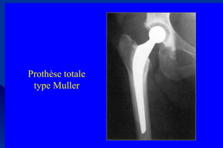 Prothèse totale
type Muller
 