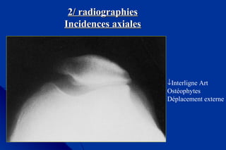 2/ radiographies2/ radiographies
Incidences axialesIncidences axiales
↓Interligne Art
Ostéophytes
Déplacement externe
 